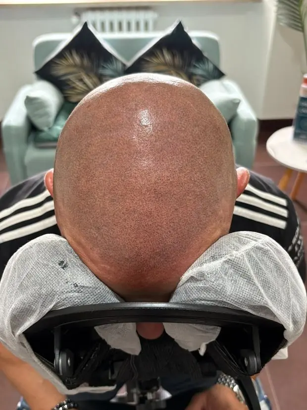 Dopo la terza seduta, effetto rasato completo
