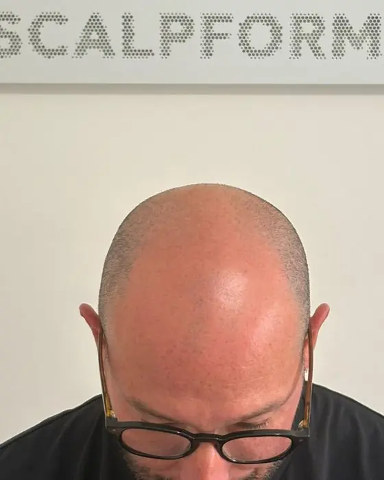 Cliente prima del trattamento, calvizie sulla parte alta della testa