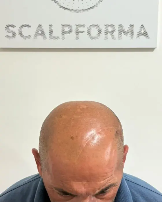 Cuoio capelluto lucido prima del trattamento
